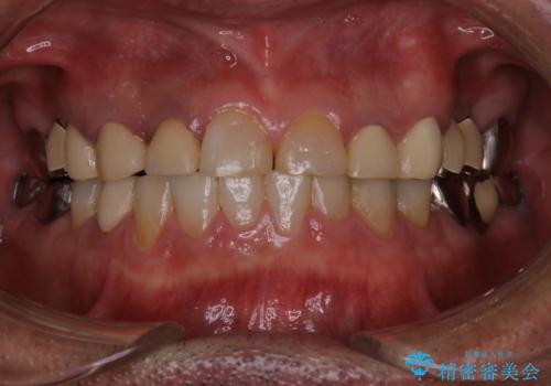 歯肉からの出血 適合の悪い銀歯をオールセラミックのブリッジにやり替えの治療前