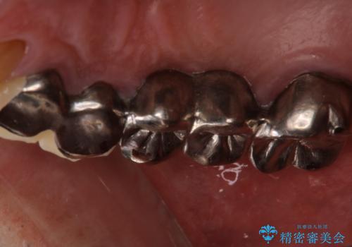 歯肉からの出血 適合の悪い銀歯をオールセラミックのブリッジにやり替えの治療前