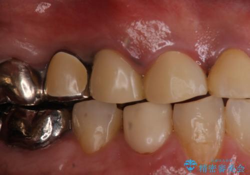 歯肉からの出血 適合の悪い銀歯をオールセラミックのブリッジにやり替えの治療前