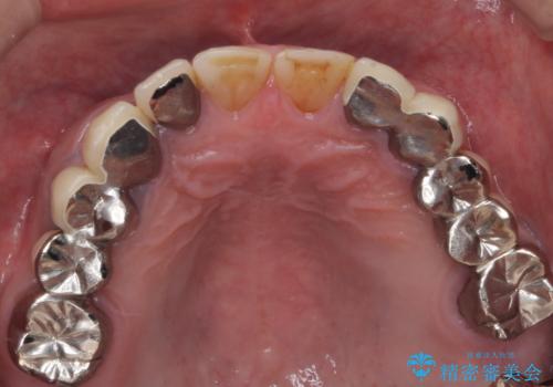 歯肉からの出血 適合の悪い銀歯をオールセラミックのブリッジにやり替えの治療前