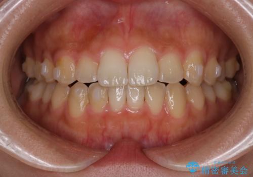 【インビザライン】がたつきをマウスピースできれいにしたいの治療中