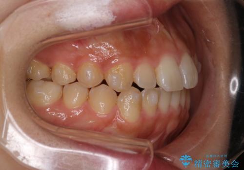 【インビザライン】がたつきをマウスピースできれいにしたいの治療中