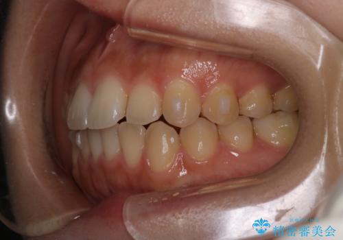 【インビザライン】がたつきをマウスピースできれいにしたいの治療中