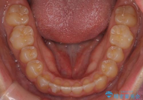 【インビザライン】がたつきをマウスピースできれいにしたいの治療中