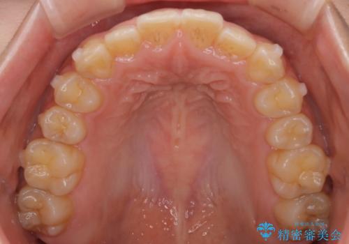 【インビザライン】がたつきをマウスピースできれいにしたいの治療中