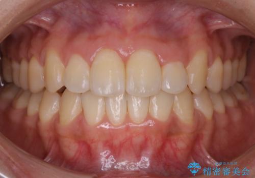 【ワイヤー矯正】前歯のがたつきを短期間で治したいの症例 治療後