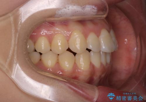 【ワイヤー矯正】前歯のがたつきを短期間で治したいの治療後