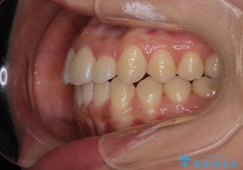 【ワイヤー矯正】前歯のがたつきを短期間で治したいの治療後