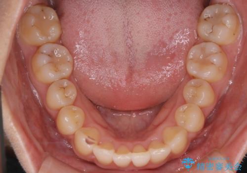 【ワイヤー矯正】前歯のがたつきを短期間で治したいの治療後