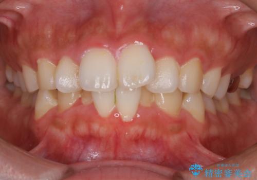 【非抜歯】インビザラインでガタつきと口元を改善!非抜歯でも印象が変わる矯正治療の治療前