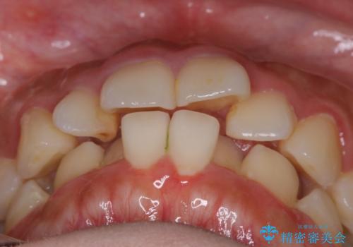 【非抜歯】インビザラインでガタつきと口元を改善!非抜歯でも印象が変わる矯正治療の治療前