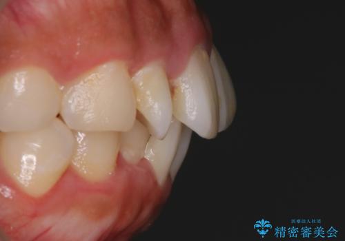 【非抜歯】インビザラインでガタつきと口元を改善!非抜歯でも印象が変わる矯正治療の治療前