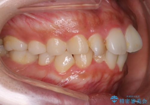 【非抜歯】インビザラインでガタつきと口元を改善!非抜歯でも印象が変わる矯正治療の治療前