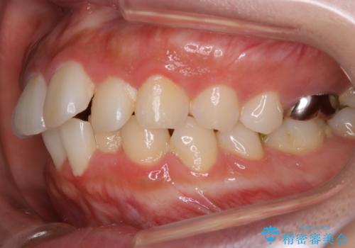 【非抜歯】インビザラインでガタつきと口元を改善!非抜歯でも印象が変わる矯正治療の治療前