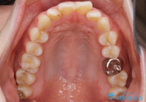 【非抜歯】インビザラインでガタつきと口元を改善!非抜歯でも印象が変わる矯正治療の治療前