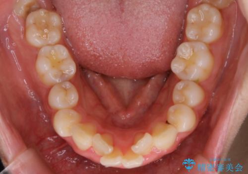 【非抜歯】インビザラインでガタつきと口元を改善!非抜歯でも印象が変わる矯正治療の治療前