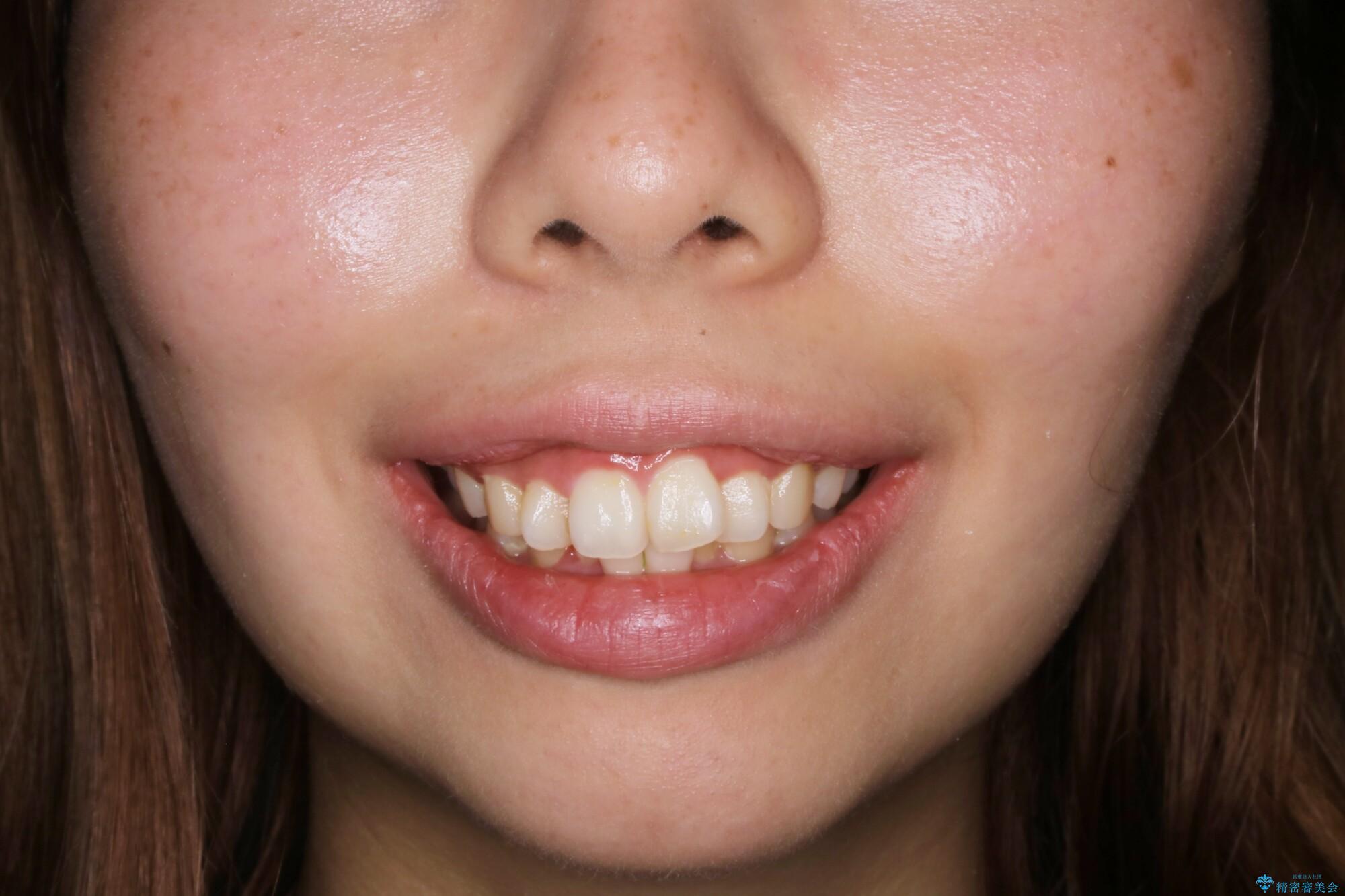 【非抜歯】インビザラインでガタつきと口元を改善!非抜歯でも印象が変わる矯正治療の治療前(顔貌)