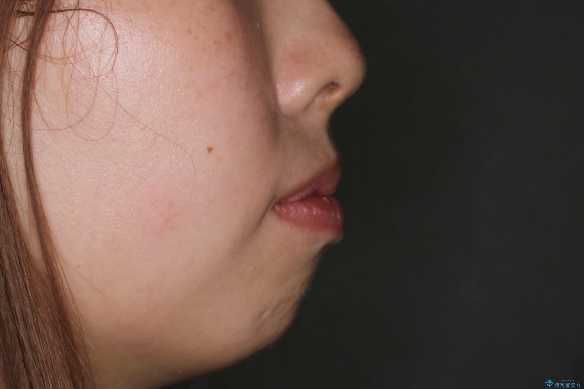 【非抜歯】インビザラインでガタつきと口元を改善!非抜歯でも印象が変わる矯正治療の治療前(顔貌)