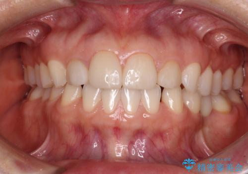 前歯を綺麗にしたい　部分矯正とセラミック治療の治療前