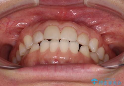 前歯を綺麗にしたい 部分矯正とセラミック治療の治療前