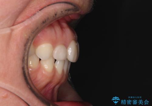 前歯を綺麗にしたい 部分矯正とセラミック治療の治療前