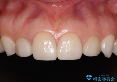 前歯を綺麗にしたい　部分矯正とセラミック治療の症例 治療前