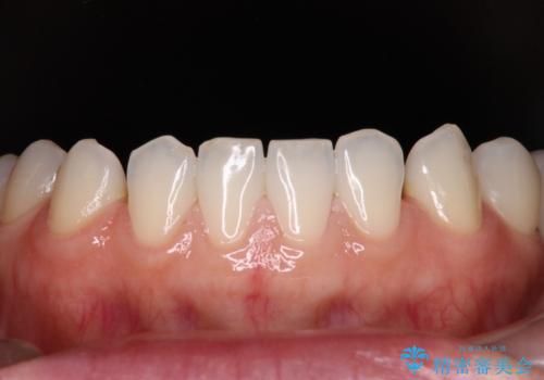 前歯を綺麗にしたい 部分矯正とセラミック治療の治療前