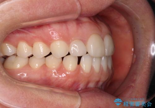 前歯を綺麗にしたい 部分矯正とセラミック治療の治療前