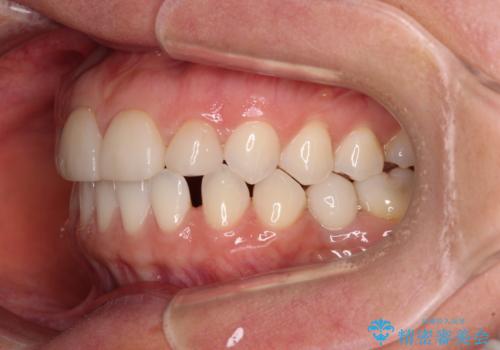 前歯を綺麗にしたい 部分矯正とセラミック治療の治療前