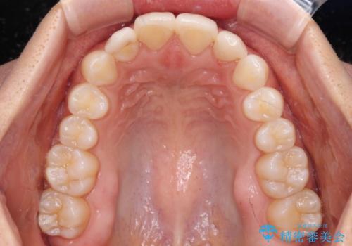 前歯を綺麗にしたい 部分矯正とセラミック治療の治療前