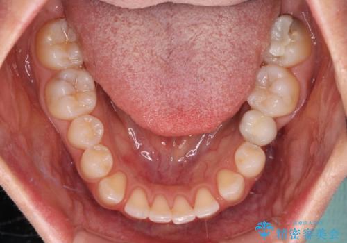 前歯を綺麗にしたい 部分矯正とセラミック治療の治療前