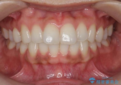 [ インビザライン ]  目立たないマウスピース矯正で、前歯のがたつきをきれいにしたいの症例 治療前