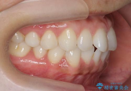 [ インビザライン ]  目立たないマウスピース矯正で、前歯のがたつきをきれいにしたいの治療前