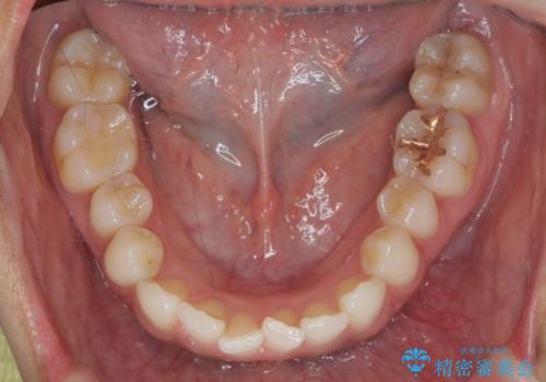 [ インビザライン ]  目立たないマウスピース矯正で、前歯のがたつきをきれいにしたいの治療前