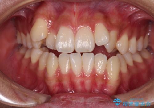 八重歯とオープンバイト　急速拡大装置を用いた矯正治療の症例 治療前