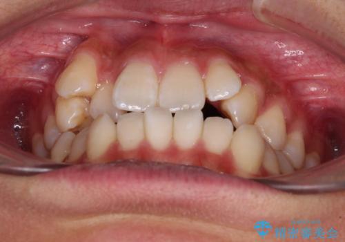 八重歯とオープンバイト 急速拡大装置を用いた矯正治療の治療前