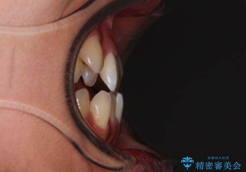 八重歯とオープンバイト 急速拡大装置を用いた矯正治療の治療前