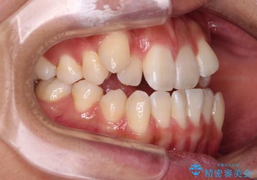 八重歯とオープンバイト 急速拡大装置を用いた矯正治療の治療前