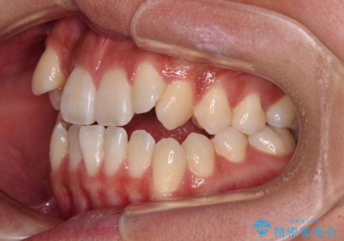 八重歯とオープンバイト 急速拡大装置を用いた矯正治療の治療前