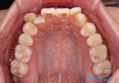 八重歯とオープンバイト　急速拡大装置を用いた矯正治療の治療前