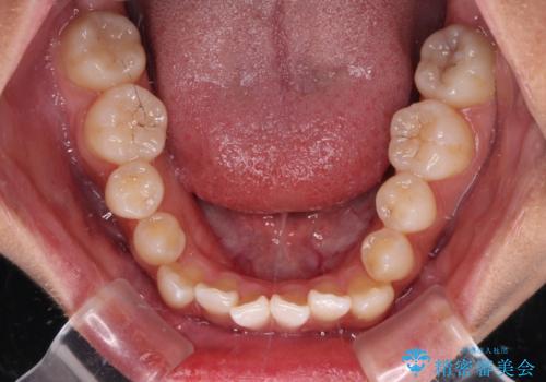 八重歯とオープンバイト 急速拡大装置を用いた矯正治療の治療前