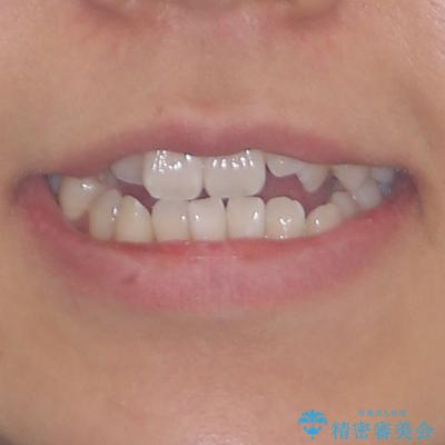 八重歯とオープンバイト 急速拡大装置を用いた矯正治療の治療前(顔貌)