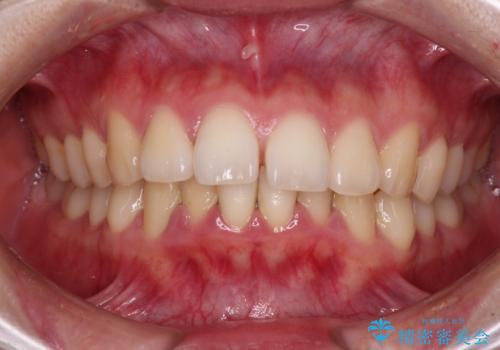 飛び出した上顎前歯 抜歯矯正でスッキリとした横顔にの症例 治療前