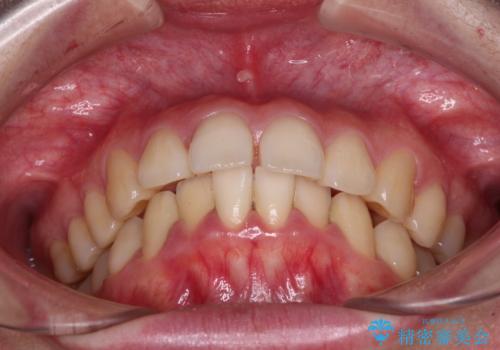 飛び出した上顎前歯 抜歯矯正でスッキリとした横顔にの治療前