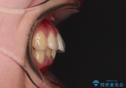 飛び出した上顎前歯 抜歯矯正でスッキリとした横顔にの治療前