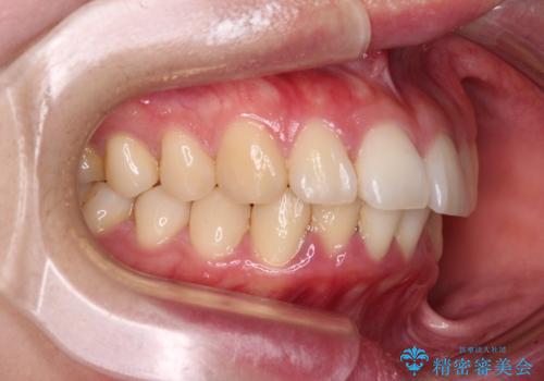 飛び出した上顎前歯 抜歯矯正でスッキリとした横顔にの治療前