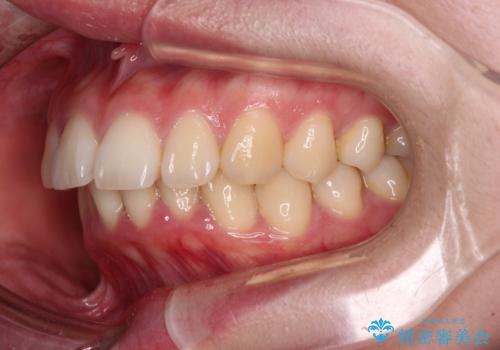 飛び出した上顎前歯 抜歯矯正でスッキリとした横顔にの治療前