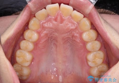 飛び出した上顎前歯 抜歯矯正でスッキリとした横顔にの治療前