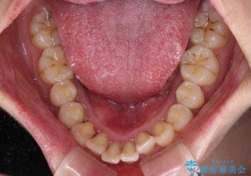 飛び出した上顎前歯 抜歯矯正でスッキリとした横顔にの治療前