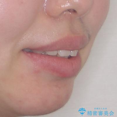 飛び出した上顎前歯 抜歯矯正でスッキリとした横顔にの治療前(顔貌)